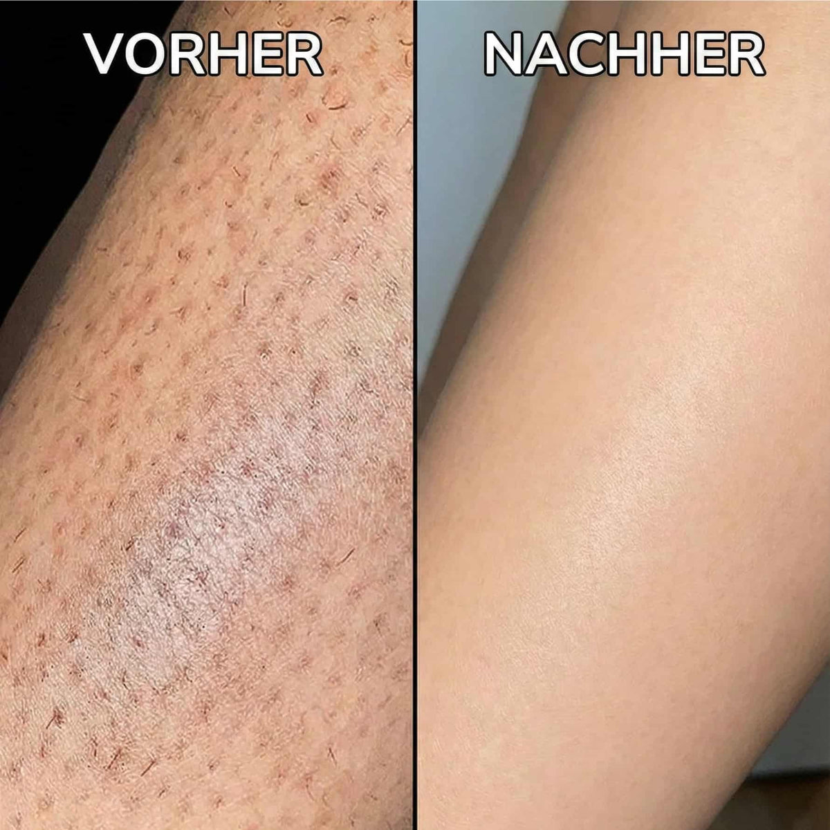 Pflanzlicher Haarwuchsstopp