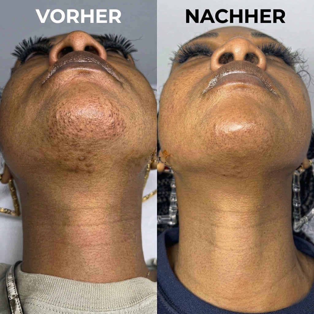 Pflanzlicher Haarwuchsstopp