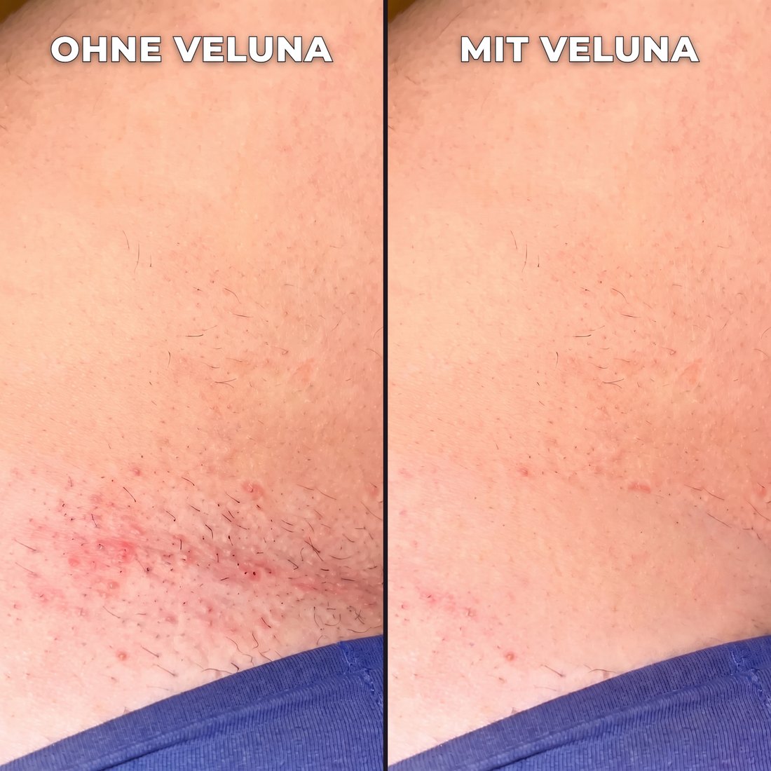 Pflanzlicher Haarwuchsstopp.