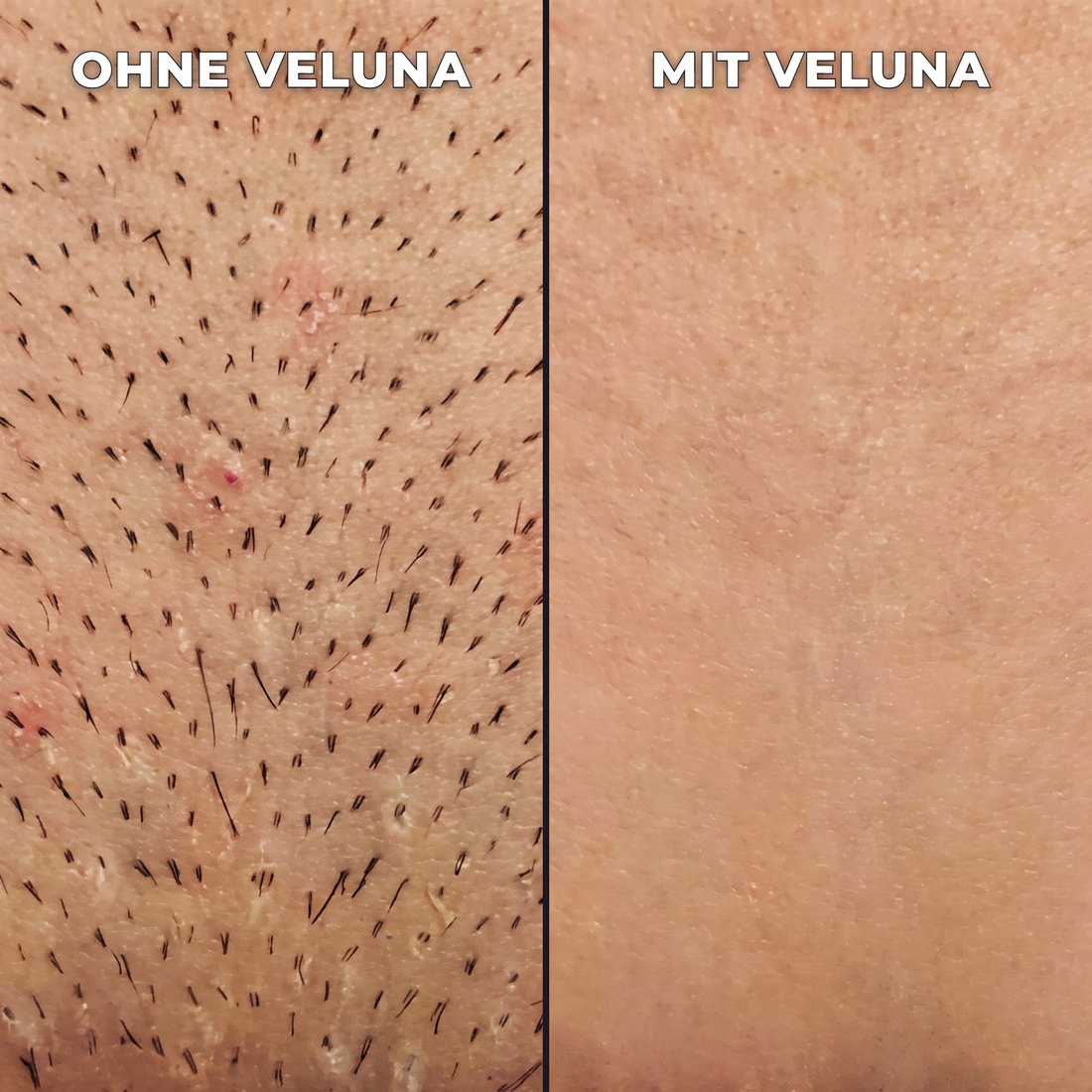 Pflanzlicher Haarwuchsstopp.